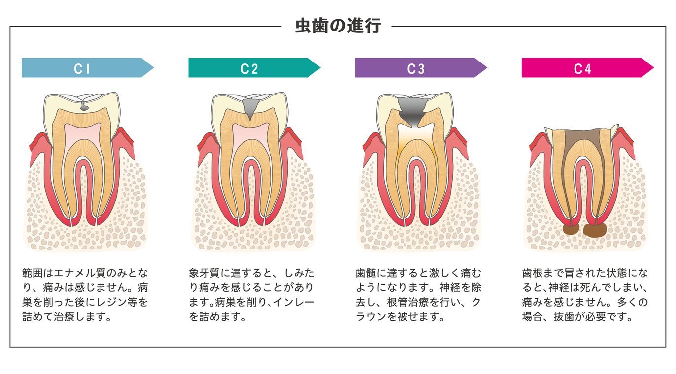 虫歯の進行｜山下歯科クリニック