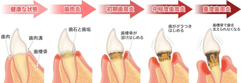 歯周病の進行